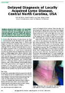 Delayed Diagnosis of Locally Acquired Lyme Disease Central North Carolina USA