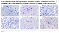 Supplementary Figure Histologic Evidence of Rickettsial Antigens in Heart AD and Liver E F Biopsy Specimens in a Patient With Fatal Fleaborne Typhus  Los Angeles County California 2022