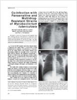 Coinfection with Pansensitive and MultidrugResistant Strains of Mycobacterium tuberculosis