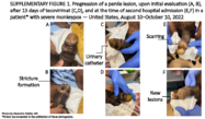Supplementary Figure 1Progression of a Penile Lesion Upon Initial Evaluation A B After 13 Days of Tecovirimat CD and at the Time of Second Hospital Admission EF in a Patient with Severe Monkeypox  United States August 10October 10 2022