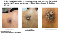 Supplementary Figure 2Progression of Necrotic Lesion on the Back of a Patient With Severe Monkeypox  United States August 10October 10 2022
