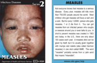 Measles