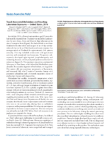 Notes From the Field TravelAssociated Melioidosis and Resulting Laboratory Exposures  US 2016
