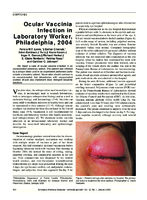 Ocular Vaccinia Infection in Laboratory Worker Philadelphia 2004