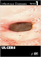 Ulcers