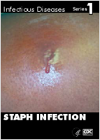 Staph infection