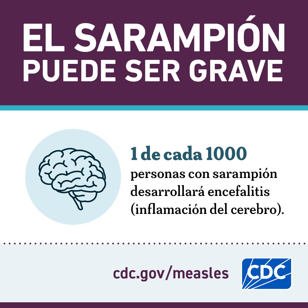 El Sarampión puede ser grave: Inflamación cerebral