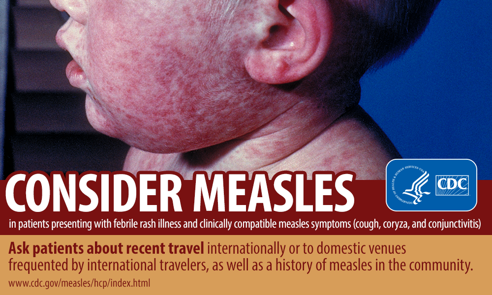 Consider measles